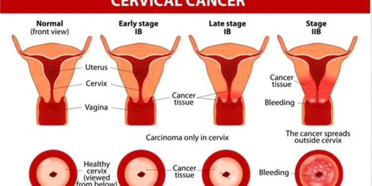 No woman must be allowed to die from cervical cancer - Clinical Epidemiologist