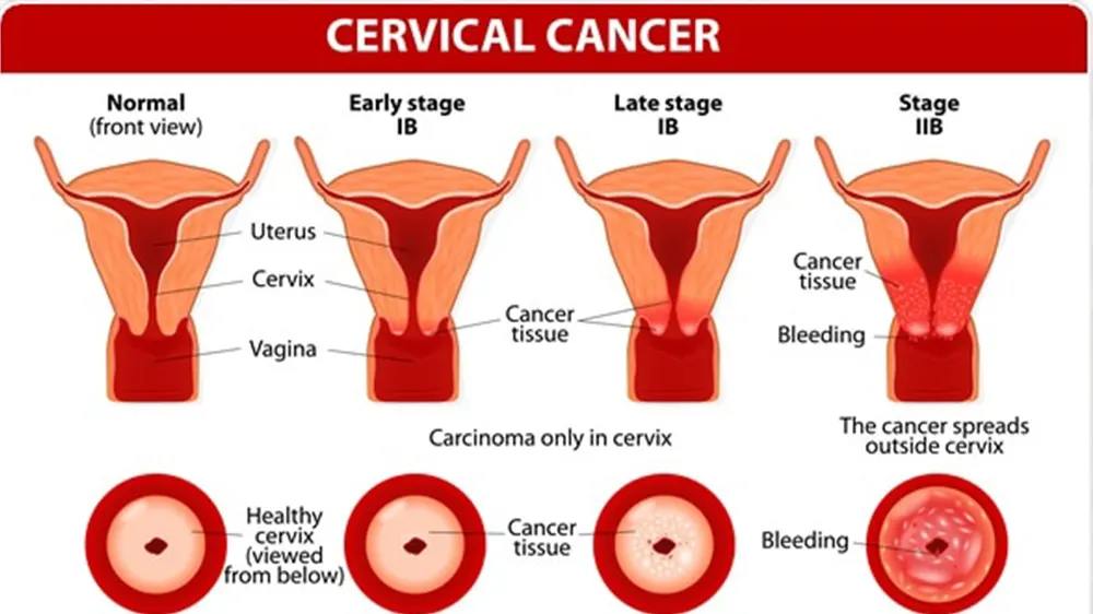 No woman must be allowed to die from cervical cancer - Clinical Epidemiologist
