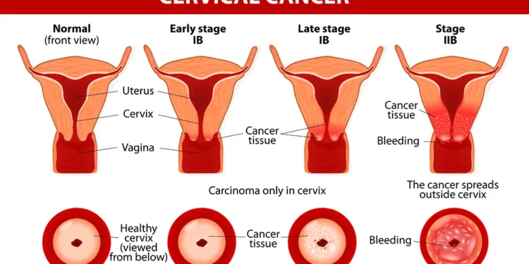 Women must avail themselves for cervical cancer screening – IMaH Medical Officer
