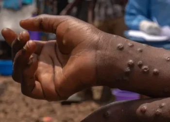 Ghana Health Service confirms 10 new Mpox cases, total rises to 565 with two deaths recorded