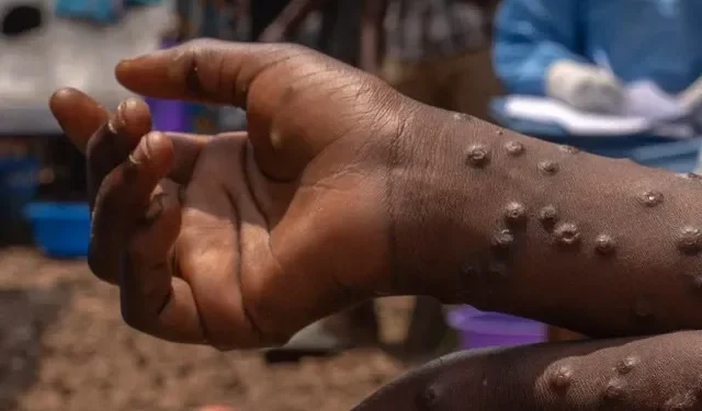 Ghana Health Service confirms 10 new Mpox cases, total rises to 565 with two deaths recorded