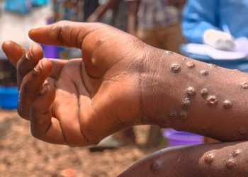 Western Region Records One Death from Mpox, 52 Active Cases