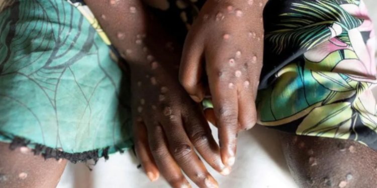 Ghana's Mpox cases climb to 947 as GHS records 13 new cases